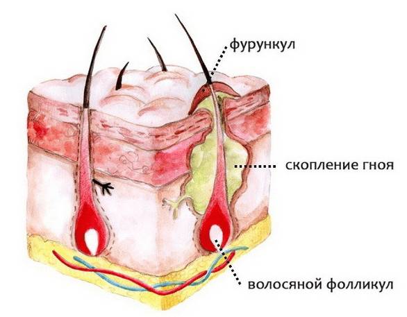 Как повлиять на период созревания фурункула