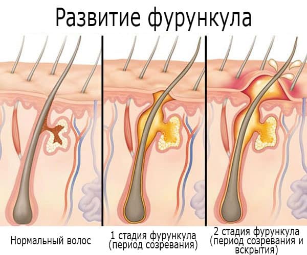 Как повлиять на период созревания фурункула