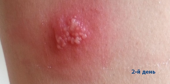 Симптомы герпеса на ногах и современные методы лечения