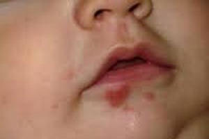 признаки герпеса на лице у ребенка