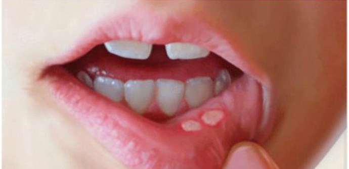 Лечение герпесной сыпи во рту