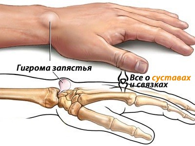 гигрома запястья