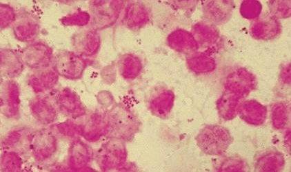 гонорея у женщин гонорея у женщин