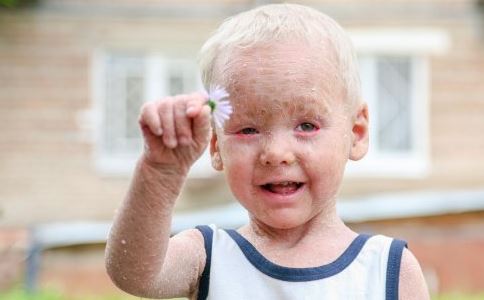 ихтиоз кожи у ребенка ихтиоз кожи у ребенка