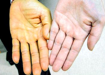 желтый оттенок рук при желтухе желтый оттенок рук при желтухе