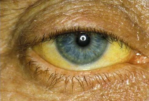 Первые признаки желтухи у взрослых