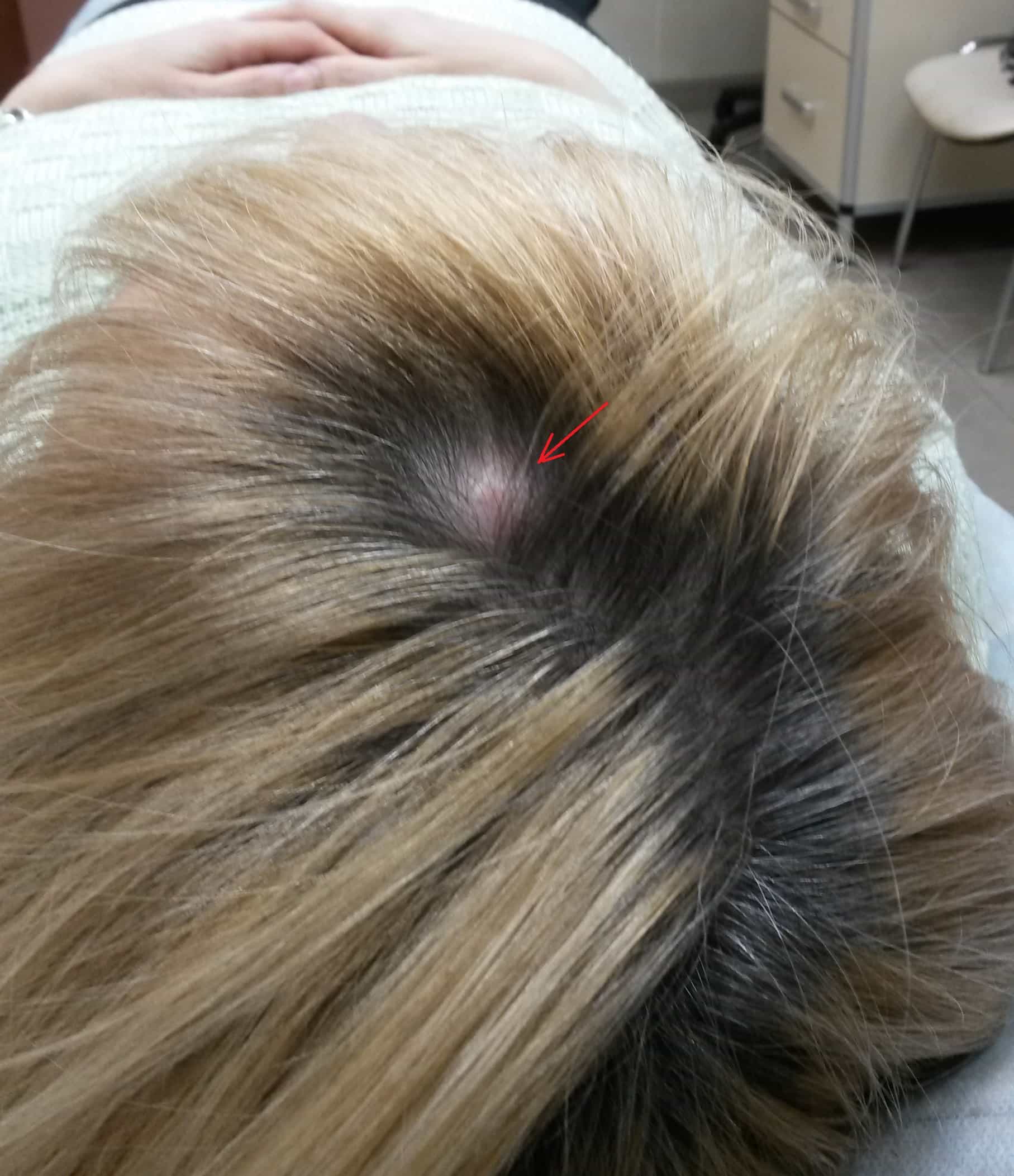 Как можно избавиться от жировика на голове