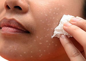 Милиумы на коже лица