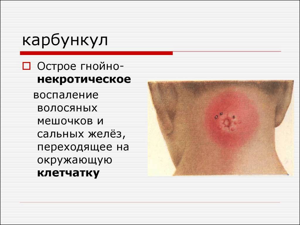 описание карбункула