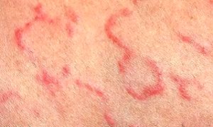 кольцевидная эритема