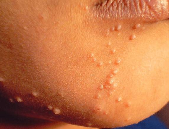 Лечение контагиозного моллюска на коже