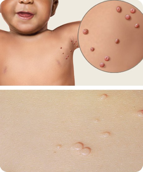 Лечение контагиозного моллюска на коже