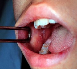 корь у детей корь у детей