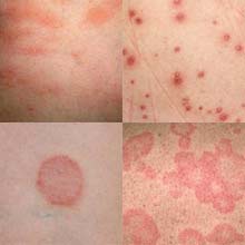 виды красных пятен на теле виды красных пятен на теле