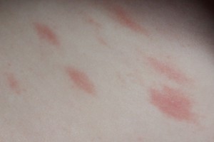 красные пятна на теле красные пятна на теле