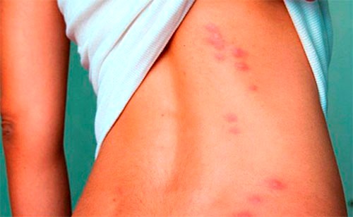 Причины красных пятен на теле