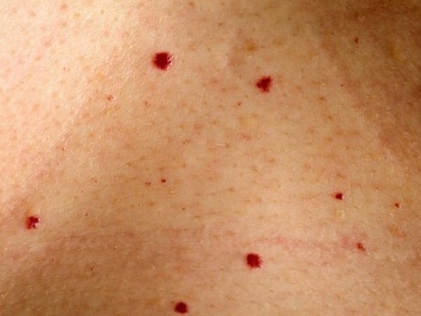 От чего появляются красные точки на теле