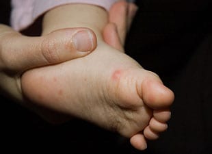 Ступни ног покрылись красными пятнами