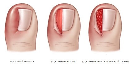 панариций пальца на руке панариций пальца на руке