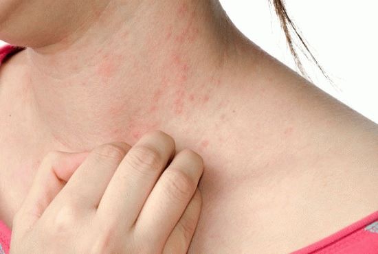 Является ли крапивница заразным заболеванием или нет