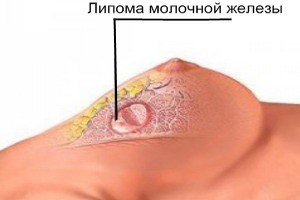 липома молочной железы липома молочной железы