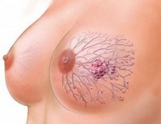 Первые признаки фибролипомы мягких тканей