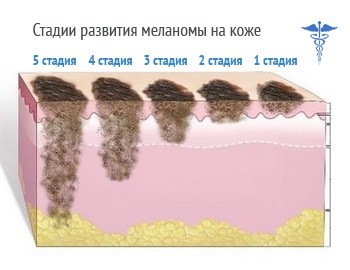 Признаки меланомы на начальной стадии