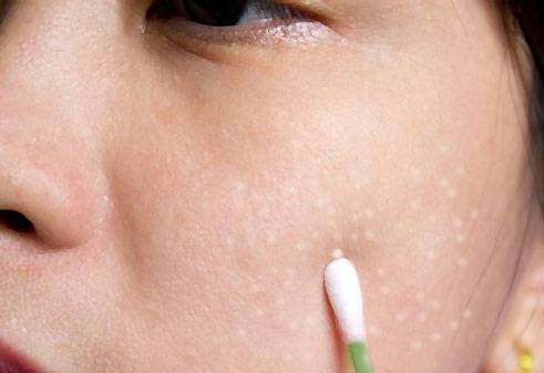 милиумы милиумы