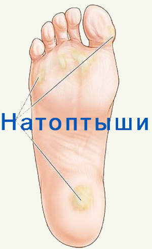 Как избавиться от бородавок на пятке