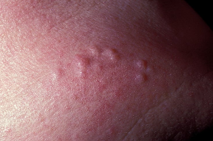 бляшки на коже бляшки на коже