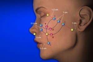 Результаты применения нитей Коги для разглаживания лица