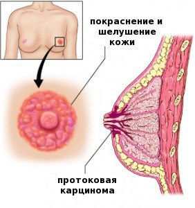 Как выявить и бороться с опухолью молочной железы Педжета