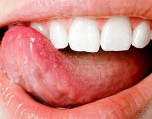 Под языком появились отростки