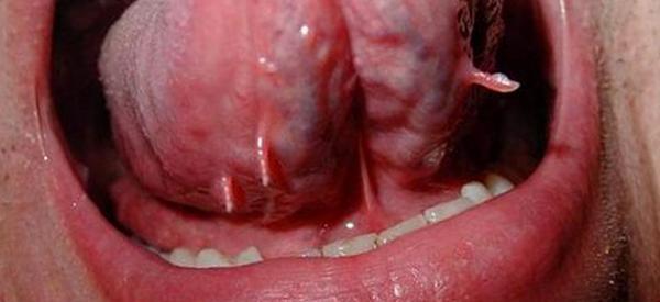 Под языком появились отростки