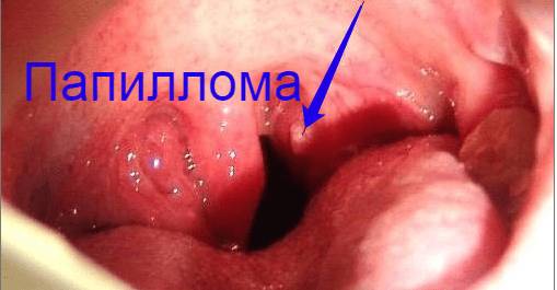 Что такое папилломатоз гортани и чем его лечить