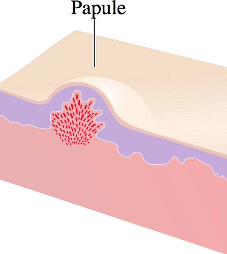 Лечение и причины папул на коже