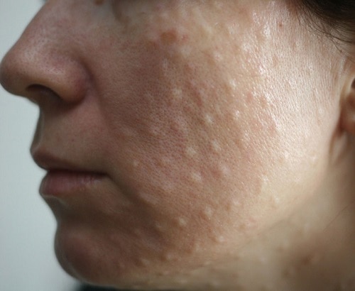 Лечение и причины папул на коже