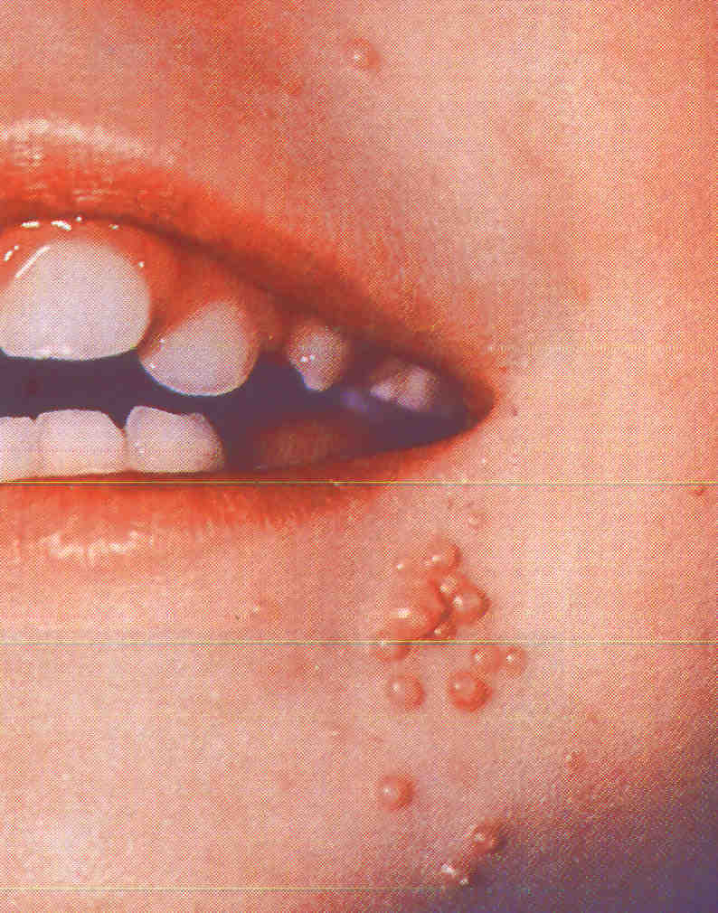 Лечение и причины папул на коже