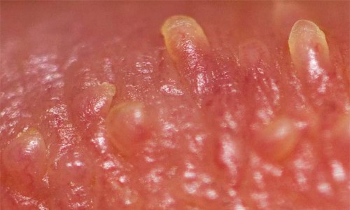 перламутровые папулы перламутровые папулы