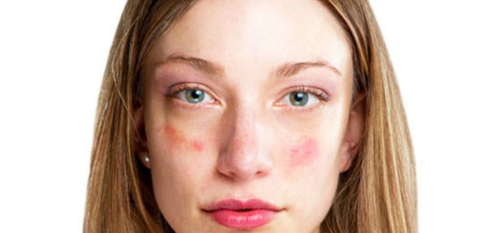 Причины возникновения красных пятен на лице