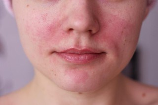 Причины возникновения красных пятен на лице