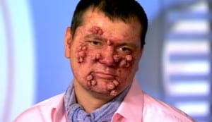 болезнь Проказа