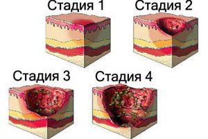 стадии формирования пролежней