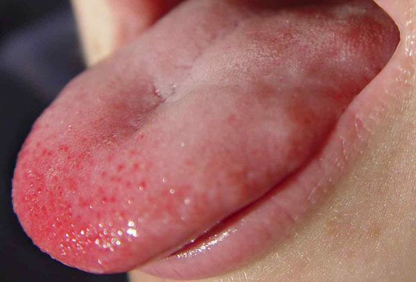 Пупырышки на языке