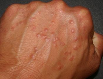 Причины водянистой сыпи на руках