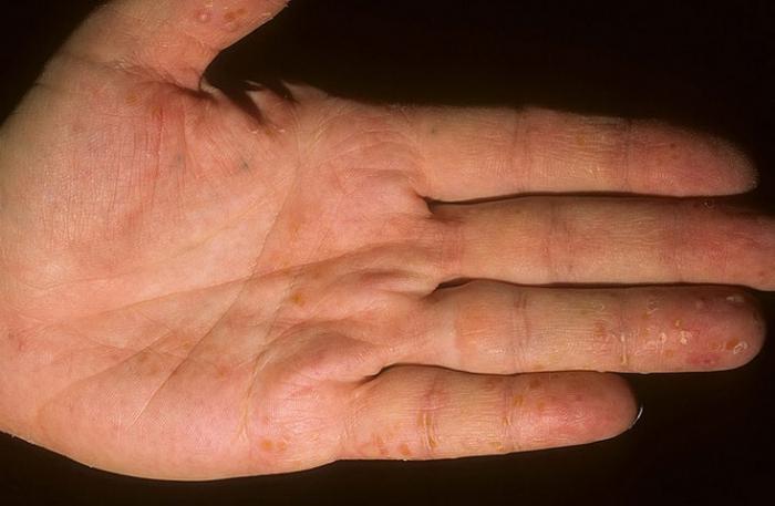 Причины водянистой сыпи на руках