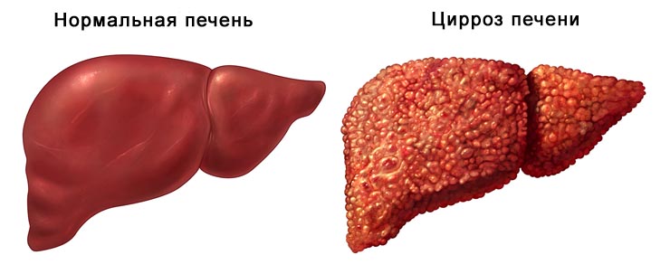 Как выглядят высыпания на коже при болезнях печени