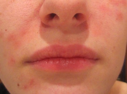 Причины возникновения красных пятен на лице