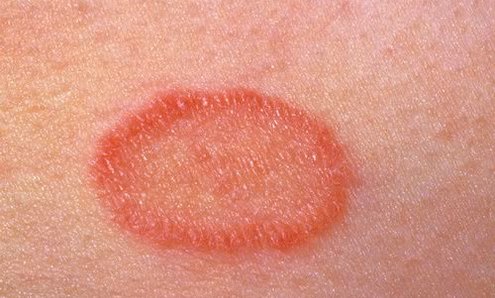 Красные шелушащиеся пятна на теле у ребенка