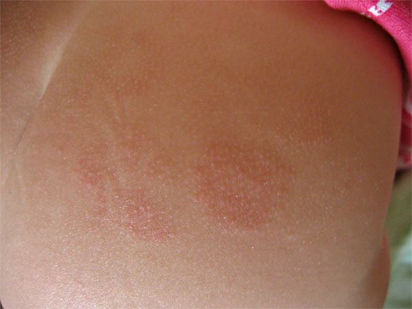 Красные шелушащиеся пятна на теле у ребенка